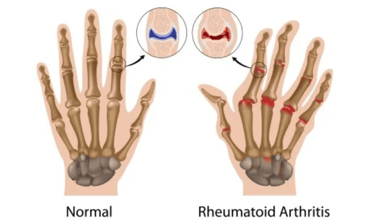 Service Provider of Rheumatoid Arthritis Ayurvedic Treatment in New Delhi, Delhi, India.